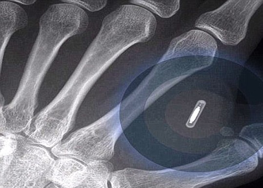 Microchip implantado na mão substitui crachá de identificação na Suécia (BioNyfiken/Divulgação)